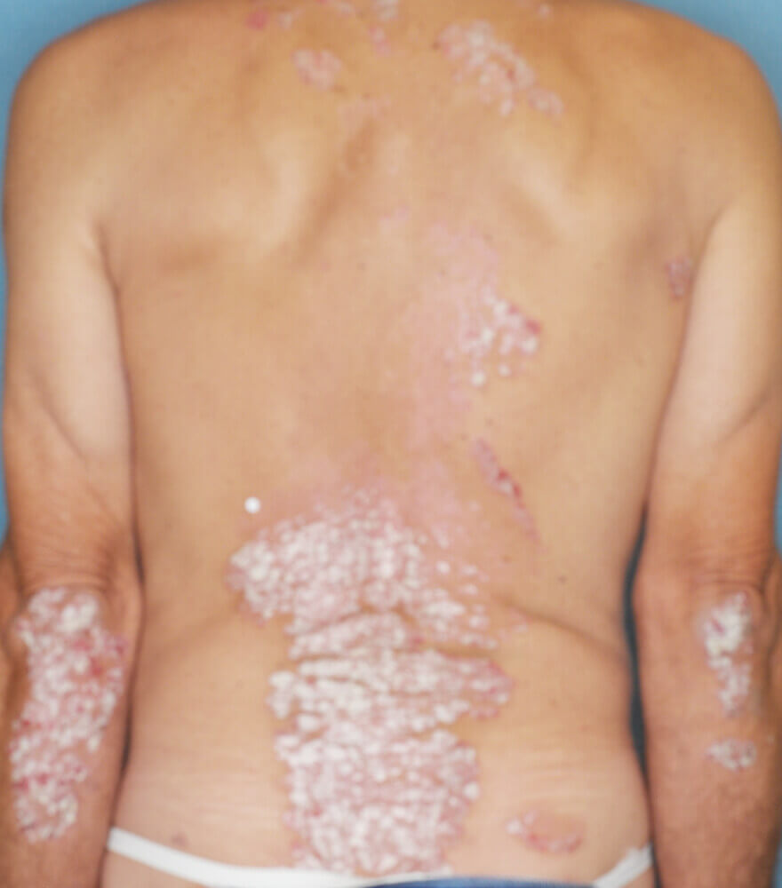 Psoriasis patient photos 30% BSA before vs 0% BSA after 3 months with SILIQ